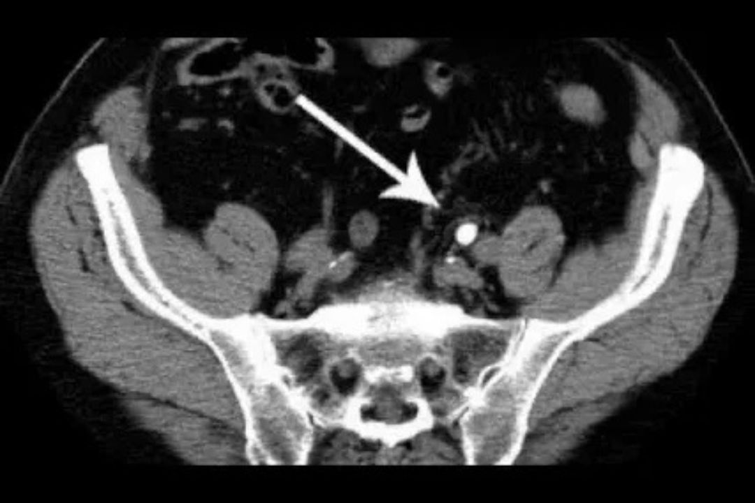 ct scan for kidney stones